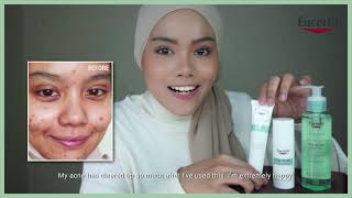 Clear Your Acne Effectively with Eucerin ProACNE Solution [upl. by Nylrebma487]